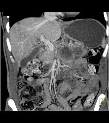 Pancreatic Cancer With Vessel Enhancement Especially PV/SMV/SV - CTisus CT Scan