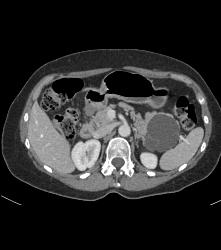 Serous Cystadenoma - CTisus CT Scan