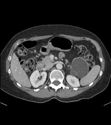 Serous Cystadenoma - CTisus CT Scan