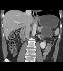 Serous Cystadenoma - CTisus CT Scan