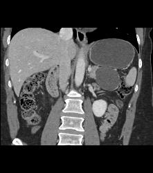 Serous Cystadenoma - CTisus CT Scan