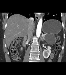 Serous Cystadenoma - CTisus CT Scan