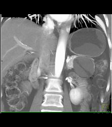 Serous Cystadenoma - CTisus CT Scan