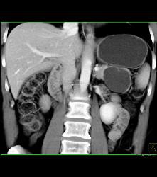 Serous Cystadenoma - CTisus CT Scan