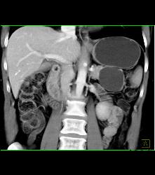 Serous Cystadenoma - CTisus CT Scan