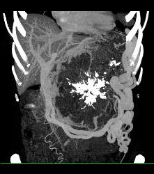 Serous Cystadenoma - CTisus CT Scan