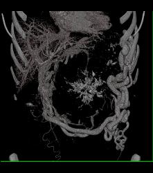 Serous Cystadenoma - CTisus CT Scan