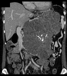 Serous Cystadenoma - CTisus CT Scan