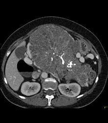 Serous Cystadenoma - CTisus CT Scan