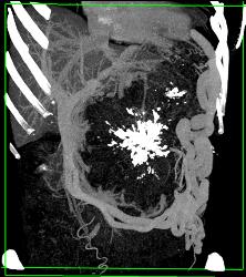 Serous Cystadenoma - CTisus CT Scan