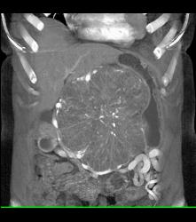 Serous Cystadenoma - CTisus CT Scan