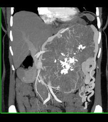 Serous Cystadenoma - CTisus CT Scan