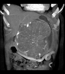 Serous Cystadenoma - CTisus CT Scan