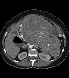 Serous Cystadenoma - CTisus CT Scan