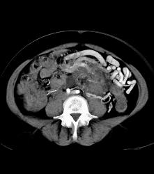 Serous Cystadenoma - CTisus CT Scan