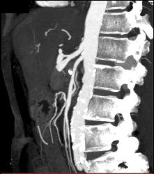 Pancreatic Cancer Encases the Superior Mesenteric Artery (SMA) and Celiac Artery and PV/SMV - CTisus CT Scan