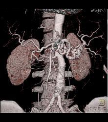 Pancreatic Cancer Encases the Superior Mesenteric Artery (SMA) and Celiac Artery and PV/SMV - CTisus CT Scan