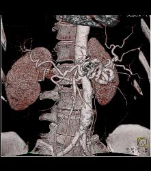 Pancreatic Cancer Encases the Superior Mesenteric Artery (SMA) and Celiac Artery and PV/SMV - CTisus CT Scan