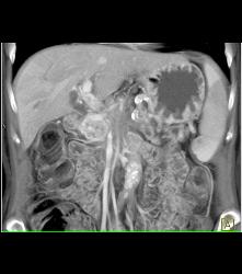 Pancreatic Cancer Encases the Superior Mesenteric Artery (SMA) and Celiac Artery and PV/SMV - CTisus CT Scan