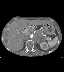 Neuroendocrine Tumor With Invasion of Left Renal Veins, Liver Mets, and Llq Mass - CTisus CT Scan