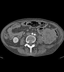 Neuroendocrine Tumor With Invasion of Left Renal Veins, Liver Mets, and Llq Mass - CTisus CT Scan