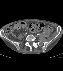 Metastatic Islet Cell Tumor - CTisus CT Scan