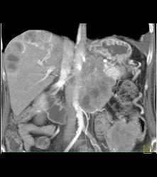 Metastatic Islet Cell Tumor - CTisus CT Scan