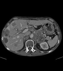 Metastatic Islet Cell Tumor - CTisus CT Scan