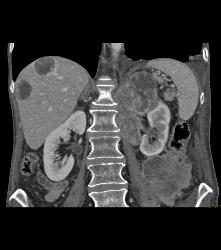 Metastatic Islet Cell Tumor - CTisus CT Scan