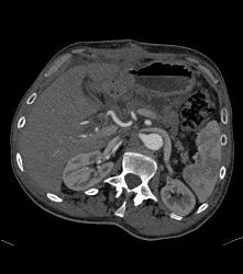 Metastatic Islet Cell Tumor - CTisus CT Scan