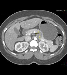 SPEN Tumor - CTisus CT Scan