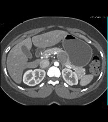 SPEN Tumor - CTisus CT Scan