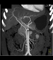 SPEN Tumor - CTisus CT Scan