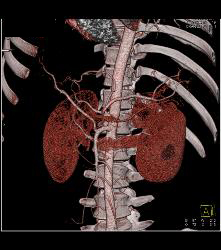 SPEN Tumor - CTisus CT Scan