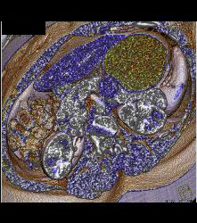 SPEN Tumor - CTisus CT Scan