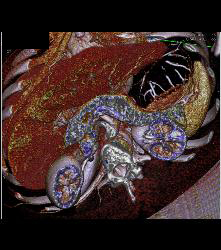 SPEN Tumor - CTisus CT Scan