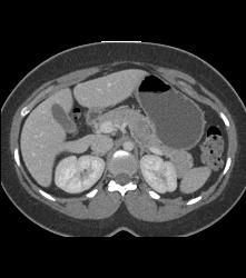 SPEN Tumor - CTisus CT Scan