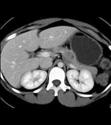 SPEN Tumor - CTisus CT Scan