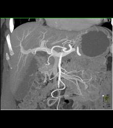 SPEN Tumor - CTisus CT Scan