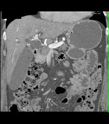 Pancreatic Cancer in Head of Pancreas - CTisus CT Scan