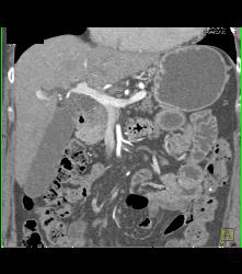 Pancreatic Cancer in Head of Pancreas - CTisus CT Scan