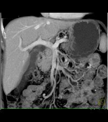 Islet Cell Tumor in Head of Pancreas - CTisus CT Scan