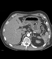 Islet Cell Tumor in Head of Pancreas - CTisus CT Scan