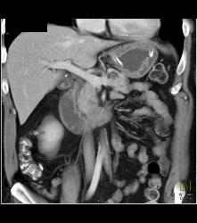 Islet Cell Tumor in Head of Pancreas - CTisus CT Scan