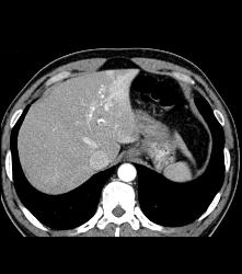 Islet Cell Tumor With Liver Metastases - CTisus CT Scan