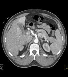 Islet Cell Tumor With Liver Metastases - CTisus CT Scan