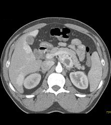 Islet Cell Tumor With Liver Metastases - CTisus CT Scan