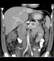 Islet Cell Tumor With Liver Metastases - CTisus CT Scan