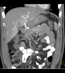 Islet Cell Tumor With Liver Metastases - CTisus CT Scan