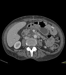 Pancreatic Adenocarcinoma - CTisus CT Scan